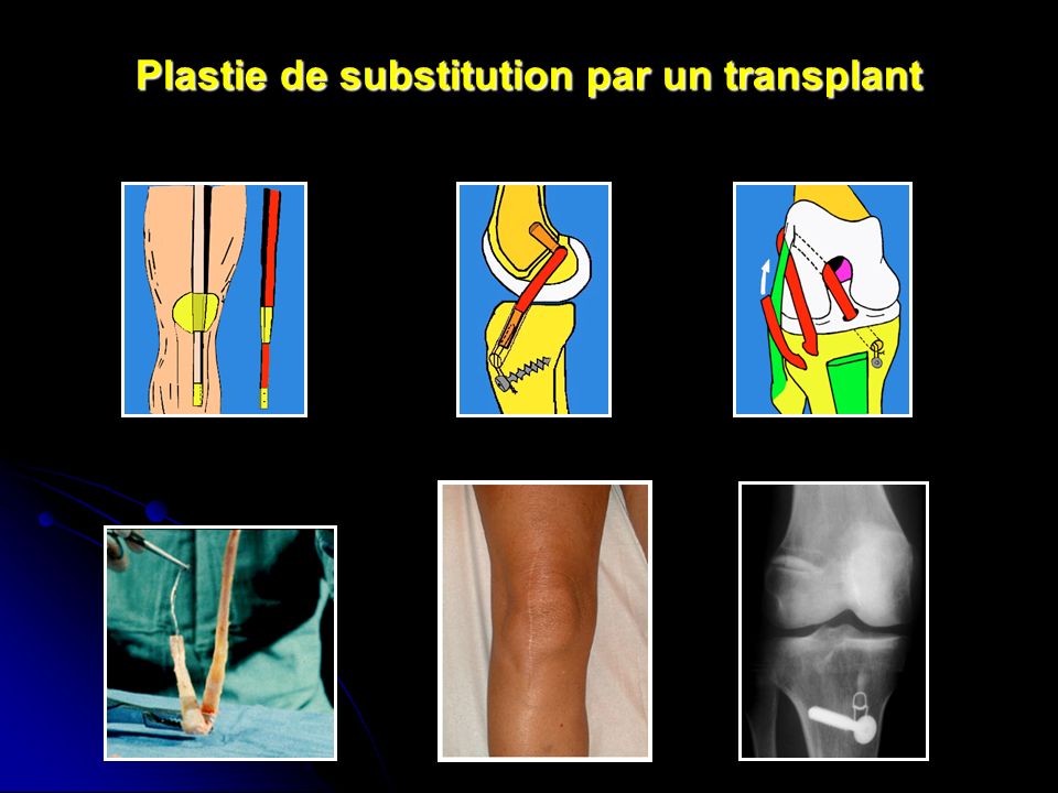 Plastie de substitution par un transplant