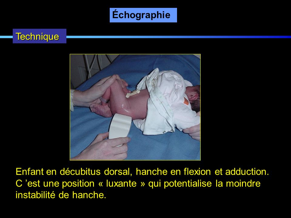Échographie Technique. Enfant en décubitus dorsal, hanche en flexion et adduction. C ’est une position « luxante » qui potentialise la moindre.