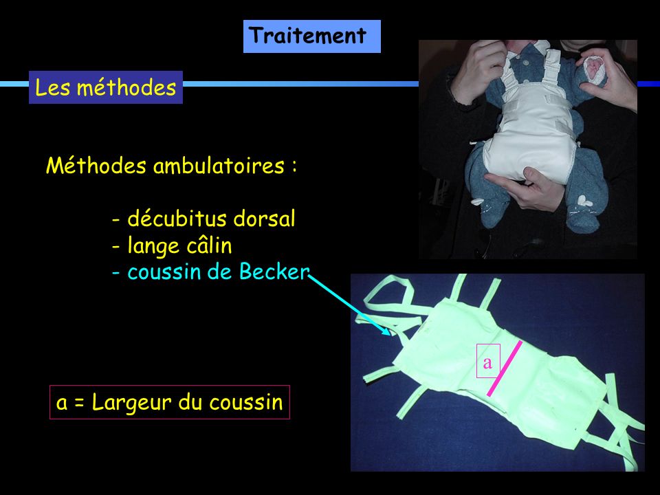Traitement Les méthodes. Méthodes ambulatoires : - décubitus dorsal. - lange câlin. - coussin de Becker.