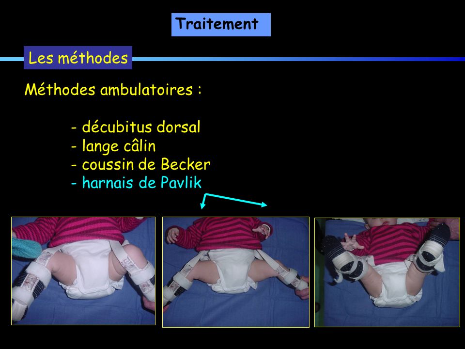 Traitement Les méthodes. Méthodes ambulatoires : - décubitus dorsal. - lange câlin. - coussin de Becker.