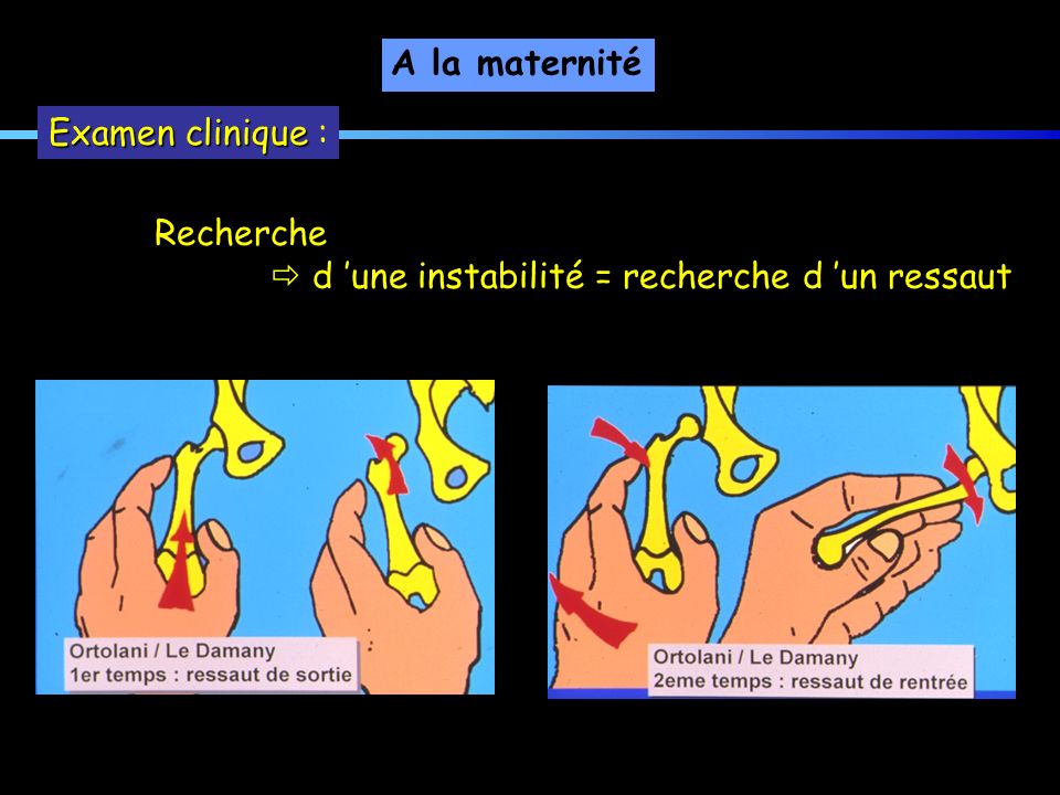 A la maternité Examen clinique : Recherche  d ’une instabilité = recherche d ’un ressaut