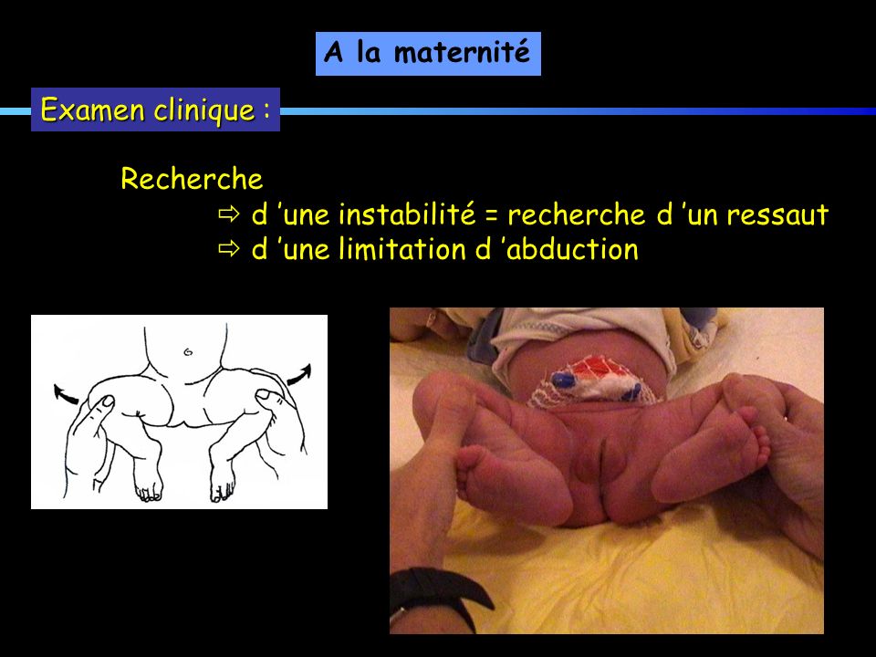 A la maternité Examen clinique : Recherche.  d ’une instabilité = recherche d ’un ressaut.