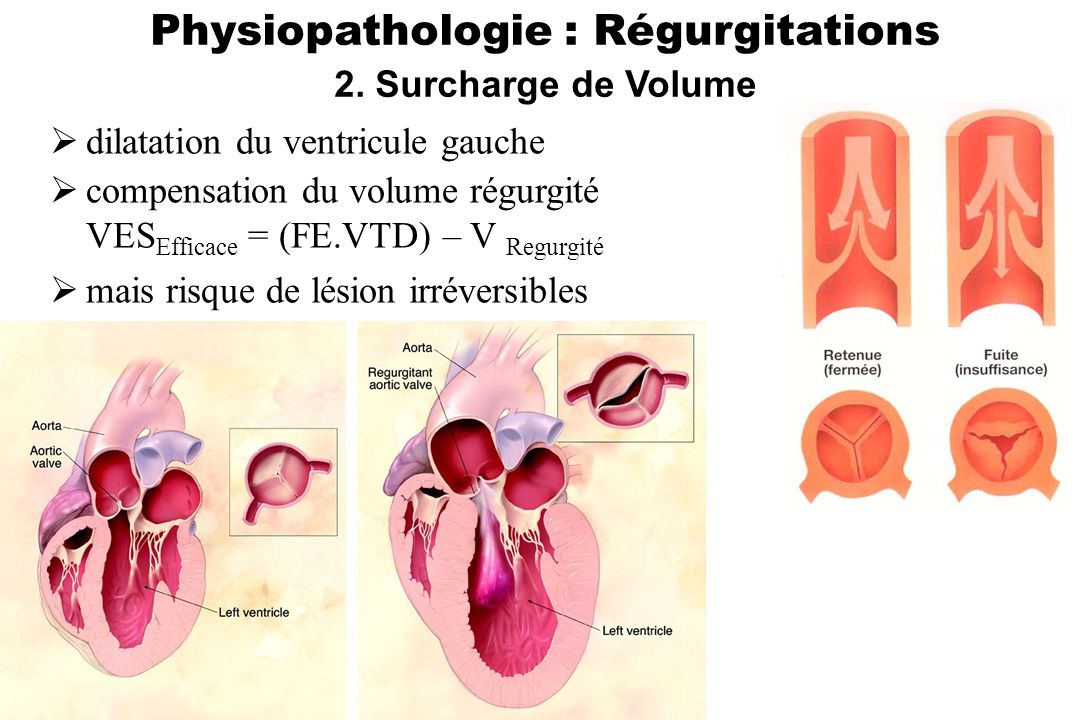 Physiopathologie : Régurgitations
