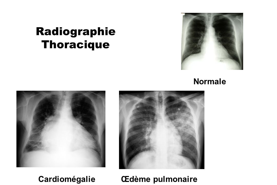 Radiographie Thoracique
