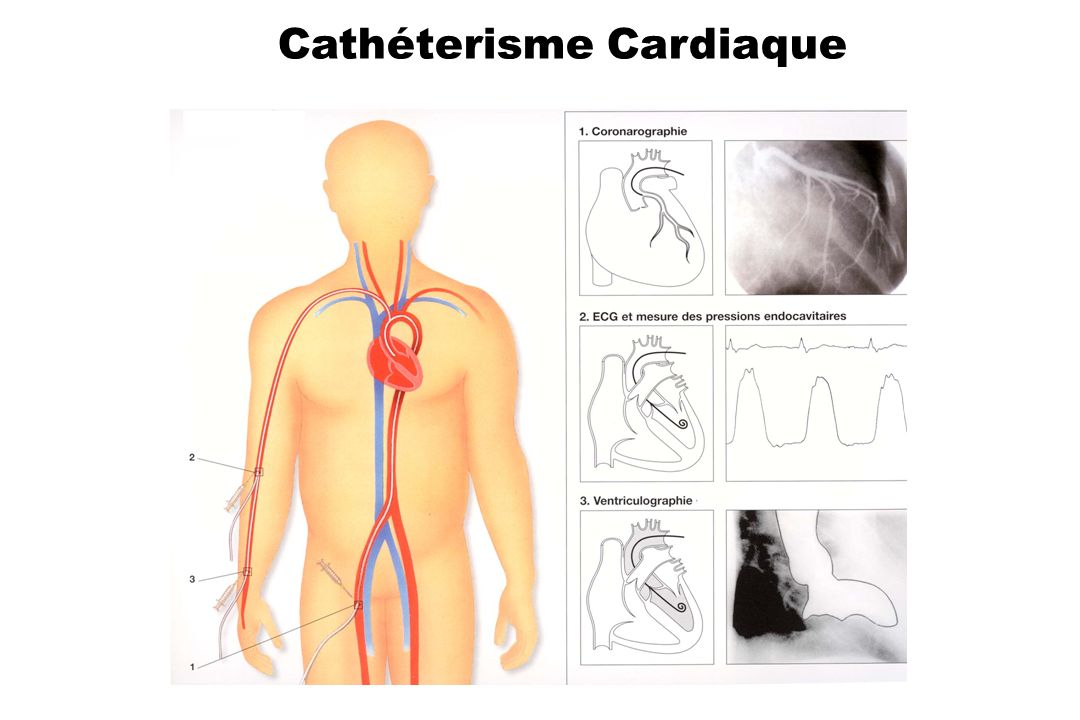 Cathéterisme Cardiaque