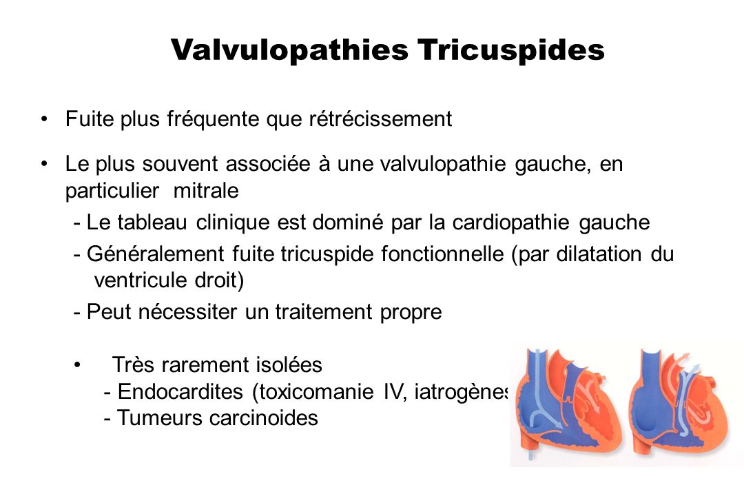 Valvulopathies Tricuspides