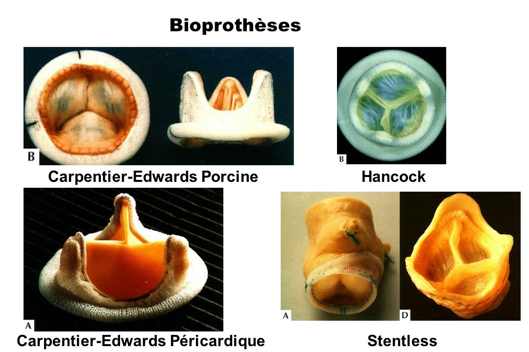 Bioprothèses Carpentier-Edwards Porcine Hancock