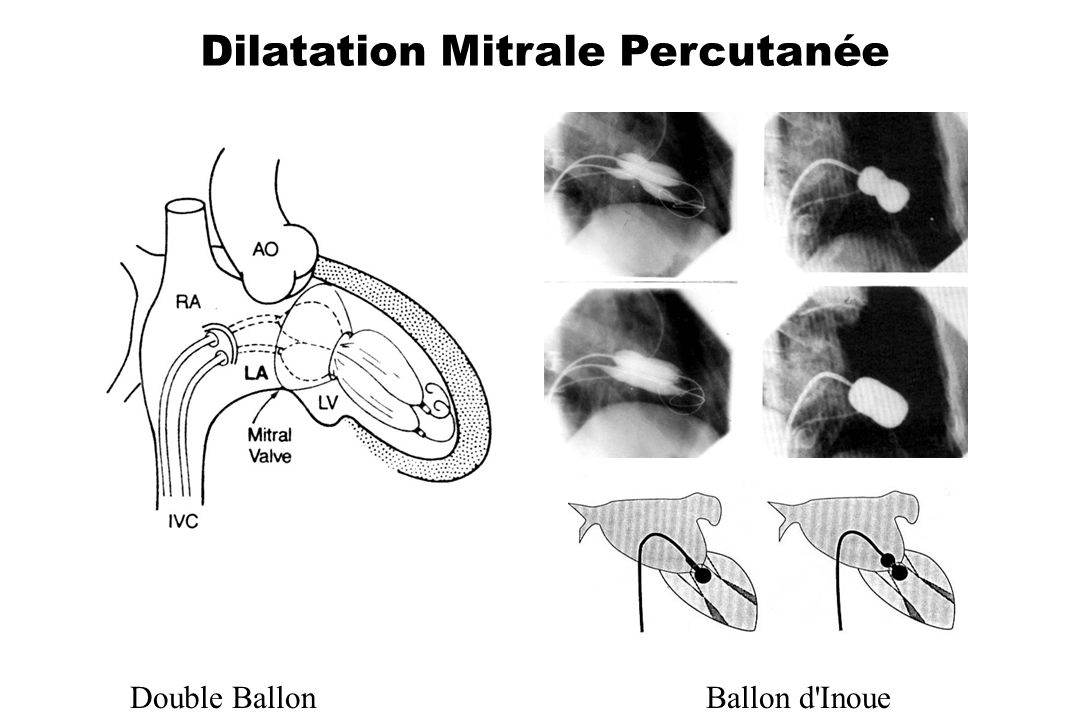 Dilatation Mitrale Percutanée