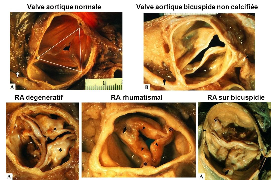 Valve aortique normale Valve aortique bicuspide non calcifiée