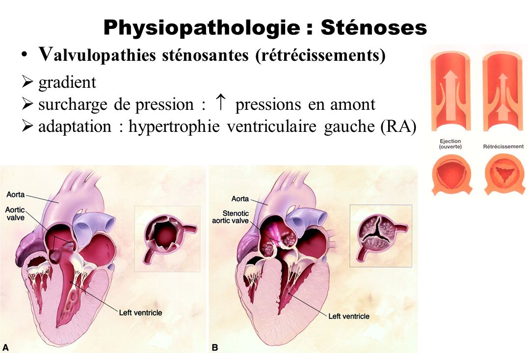 Physiopathologie : Sténoses
