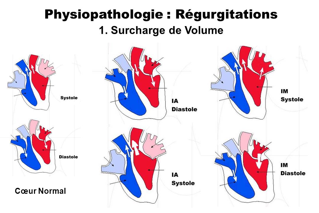 Physiopathologie : Régurgitations