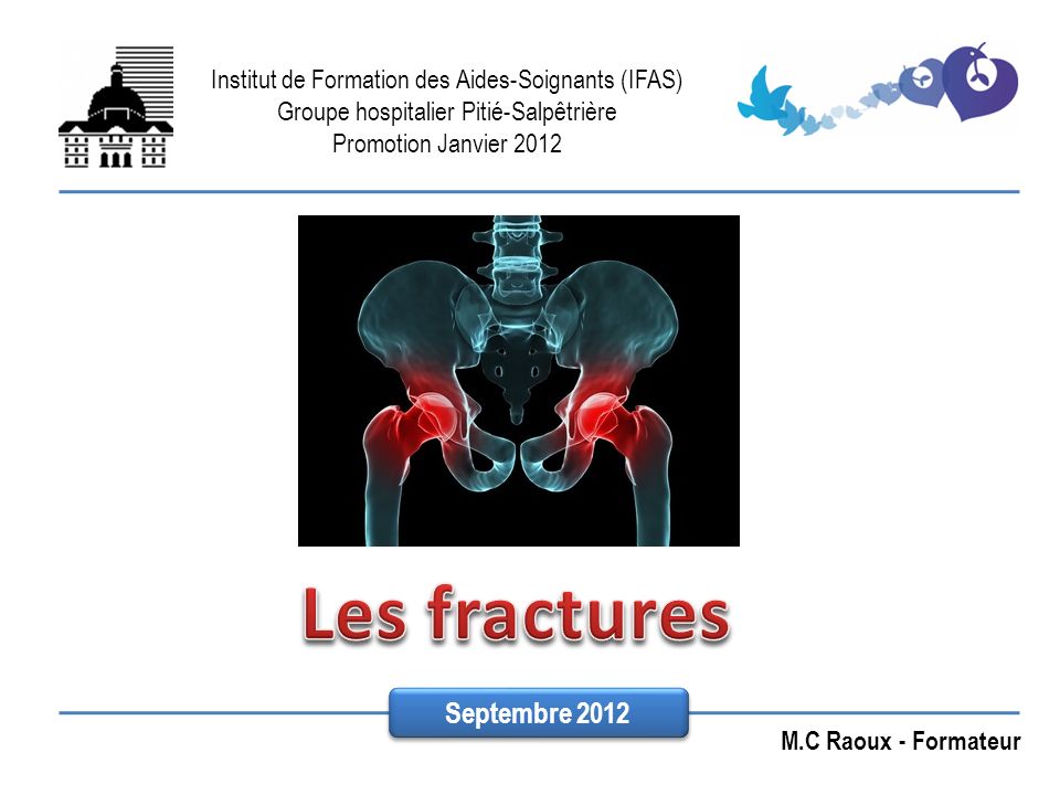 Les fractures Septembre 2012