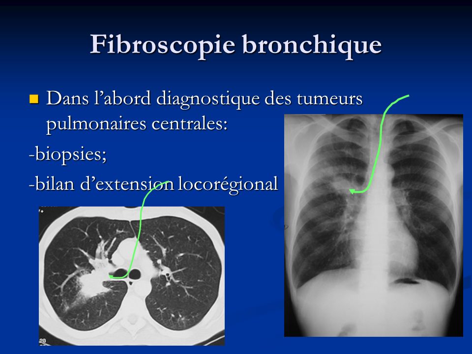 Fibroscopie bronchique