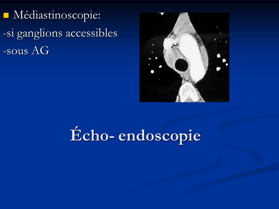 Médiastinoscopie: -si ganglions accessibles -sous AG Écho- endoscopie