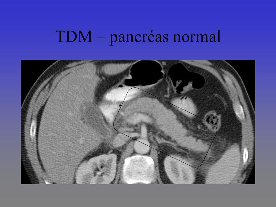 TDM – pancréas normal
