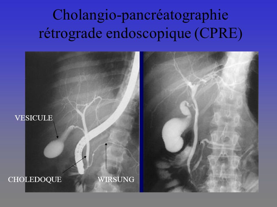 Cholangio-pancréatographie rétrograde endoscopique (CPRE)