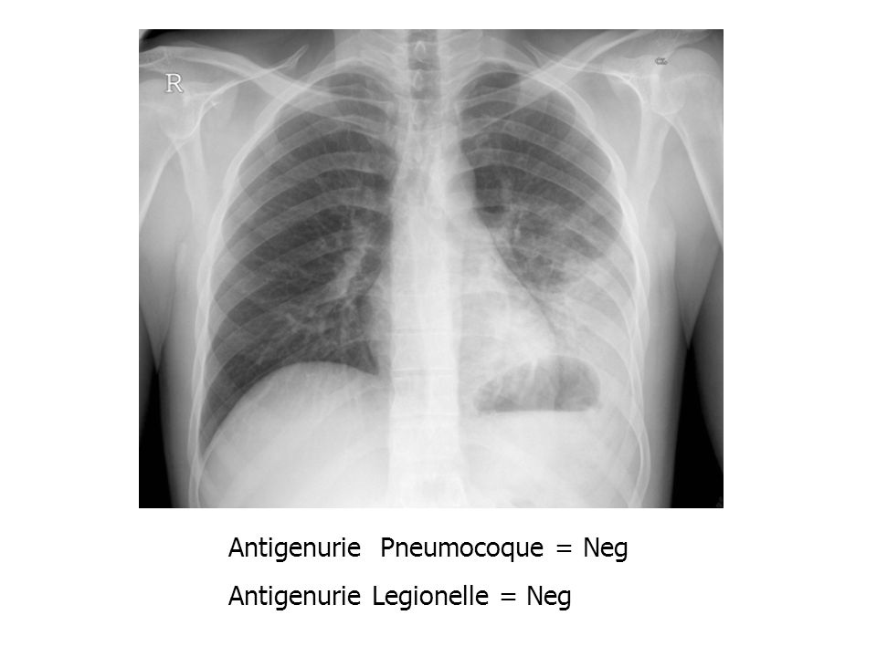 Antigenurie Pneumocoque = Neg