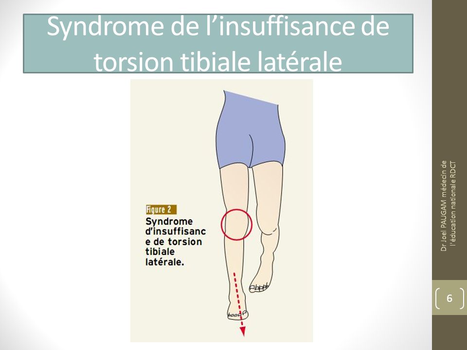 Syndrome de l’insuffisance de torsion tibiale latérale
