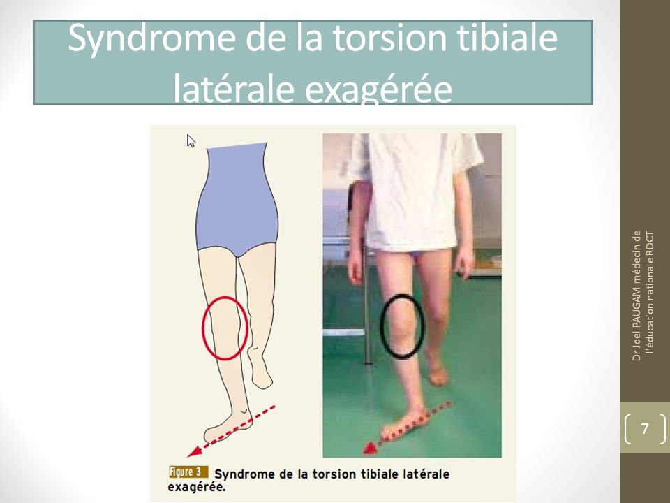 Syndrome de la torsion tibiale latérale exagérée