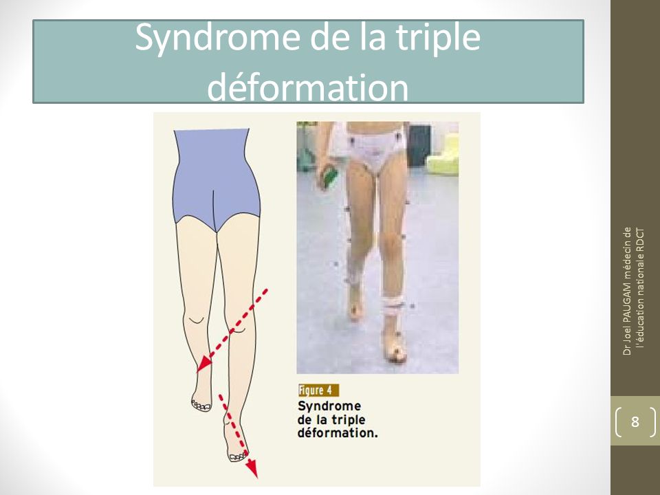 Syndrome de la triple déformation