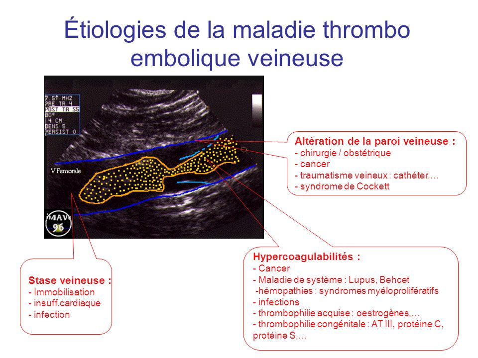 Étiologies de la maladie thrombo embolique veineuse