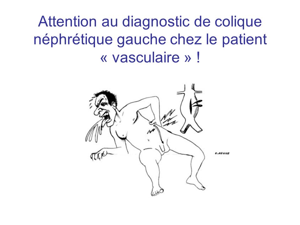 Attention au diagnostic de colique néphrétique gauche chez le patient « vasculaire » !