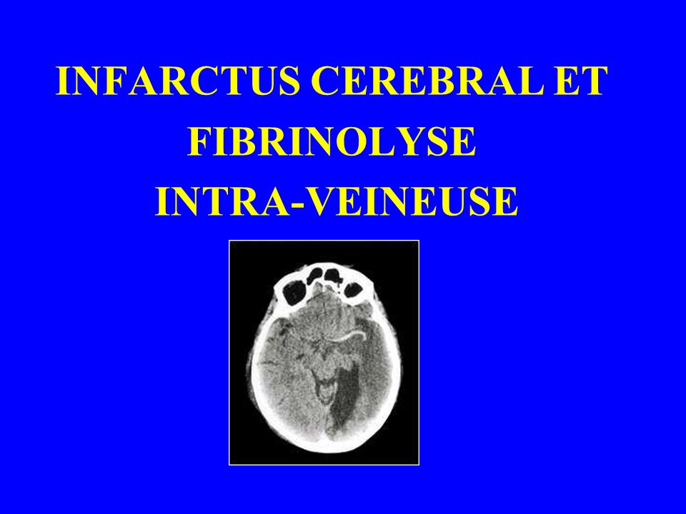 INFARCTUS CEREBRAL ET FIBRINOLYSE INTRA-VEINEUSE