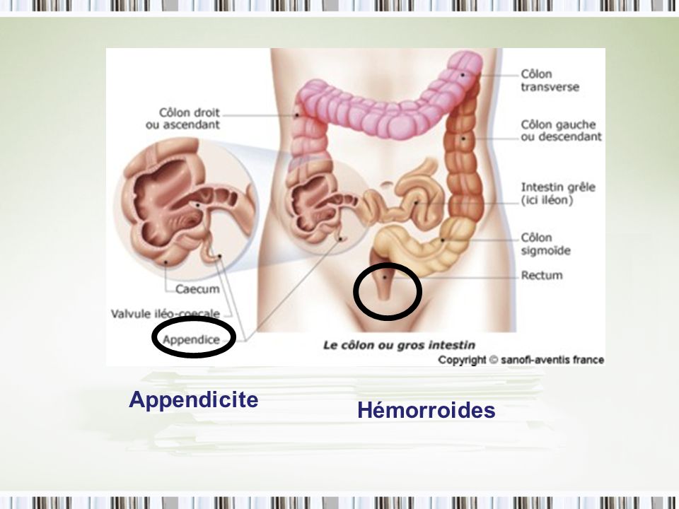 Appendicite Hémorroides