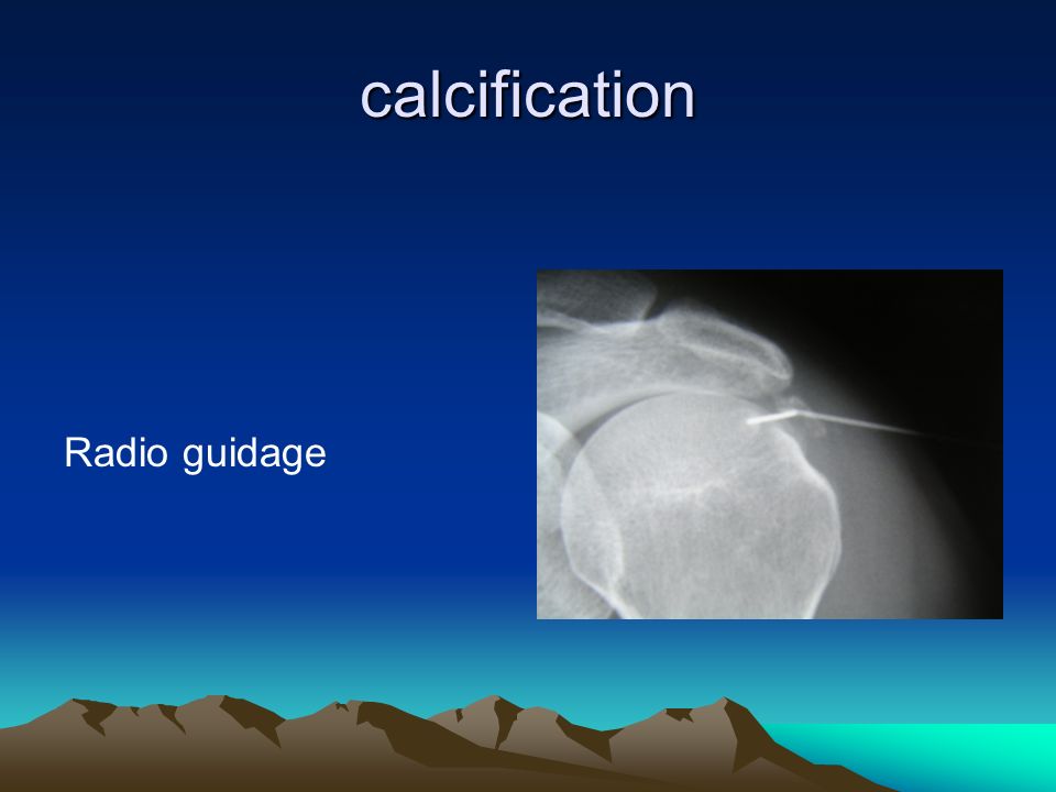 calcification Radio guidage