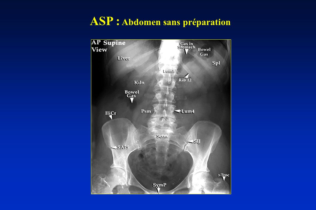 ASP : Abdomen sans préparation