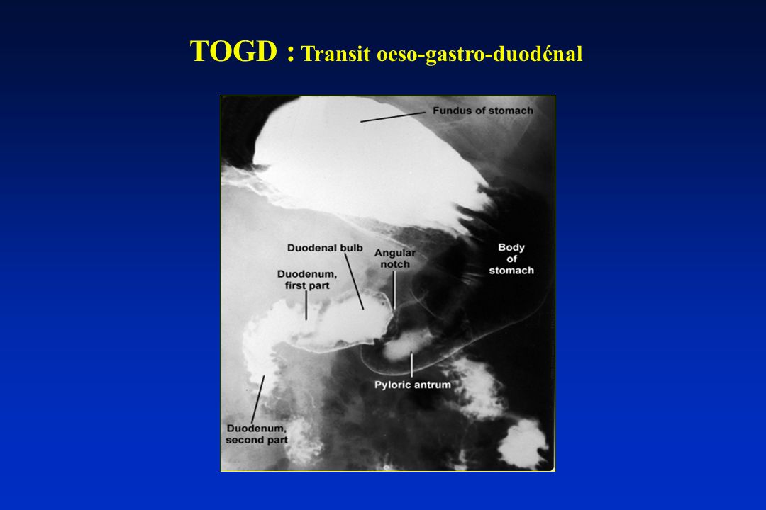 TOGD : Transit oeso-gastro-duodénal