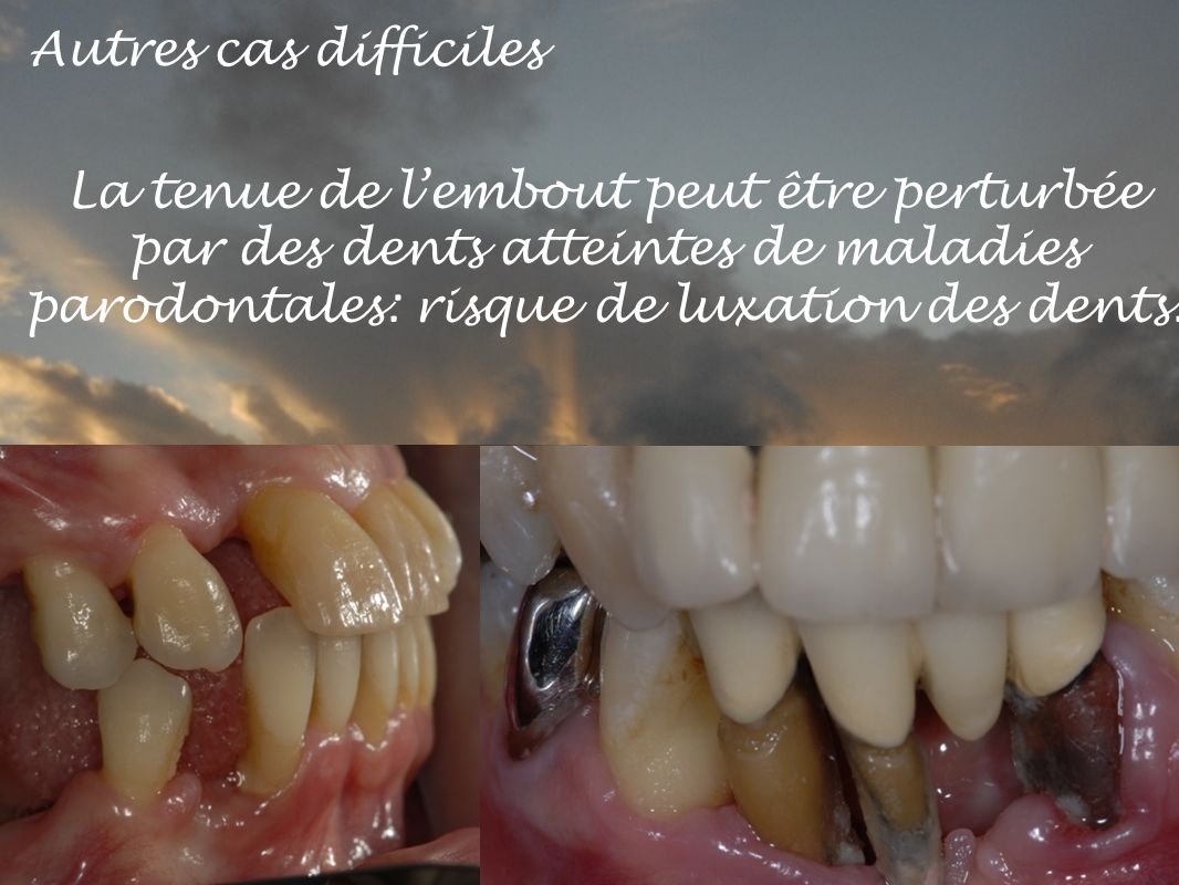 Autres cas difficiles La tenue de l’embout peut être perturbée par des dents atteintes de maladies parodontales: risque de luxation des dents.