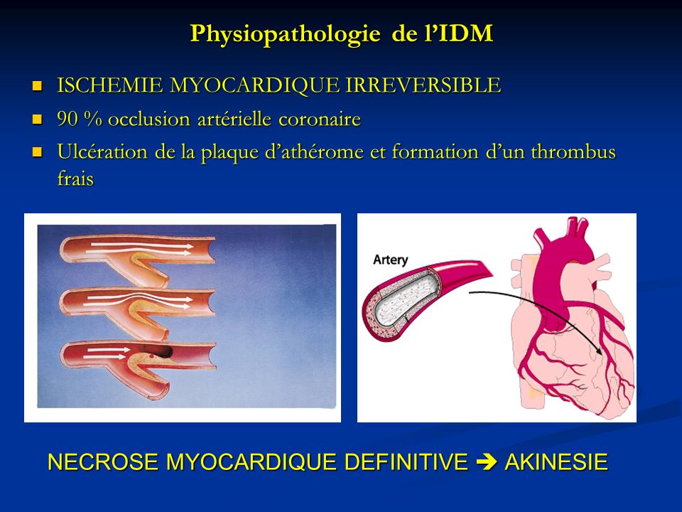 Physiopathologie de l’IDM