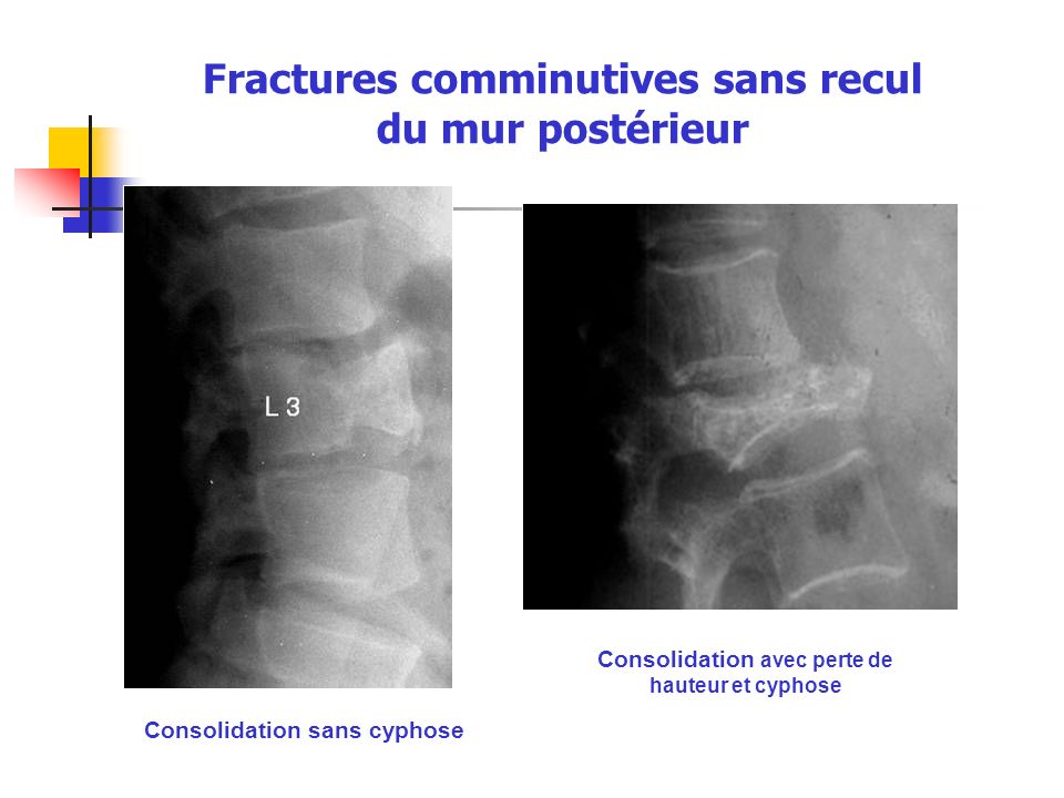 Fractures Et Luxations Du Rachis Cervical Ppt T L Charger