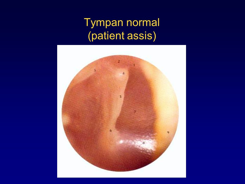 Tympan normal (patient assis)