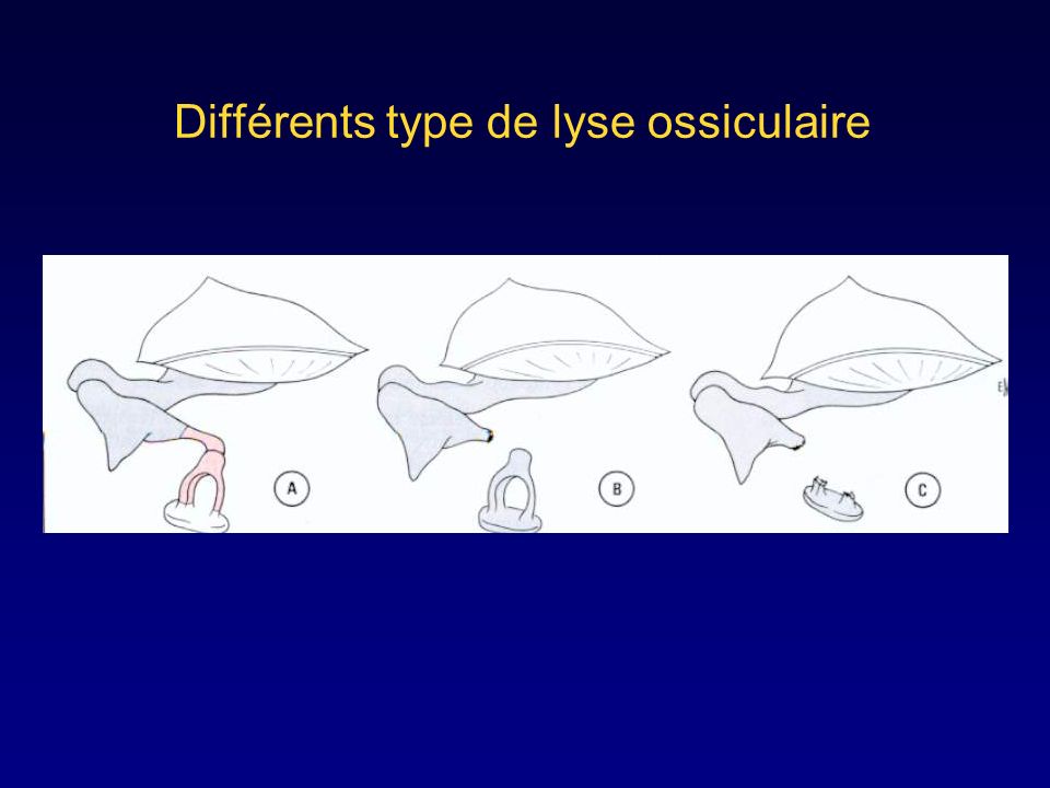 Différents type de lyse ossiculaire