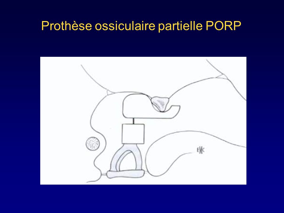 Prothèse ossiculaire partielle PORP