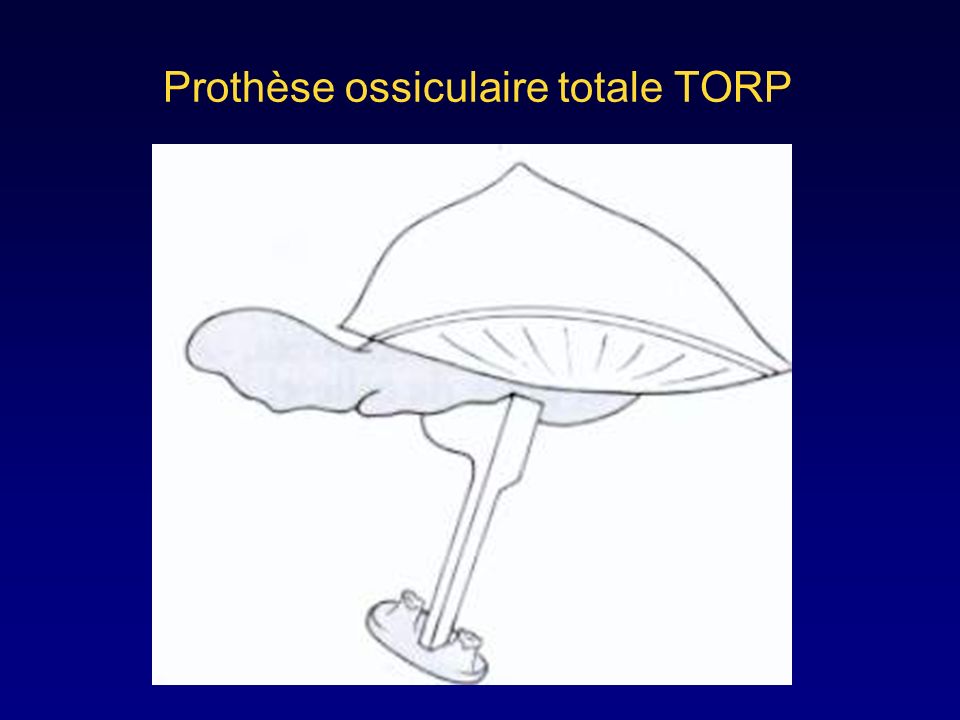 Prothèse ossiculaire totale TORP