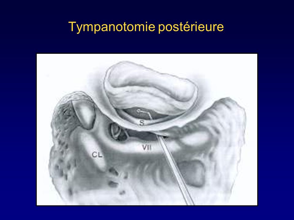 Tympanotomie postérieure
