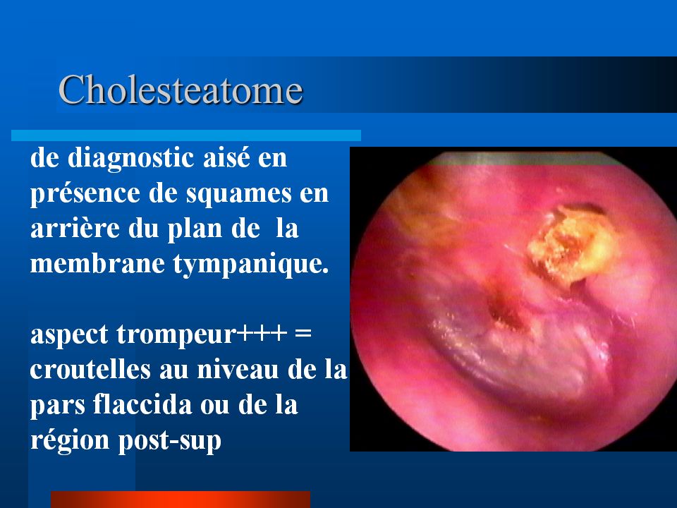 Cholesteatome