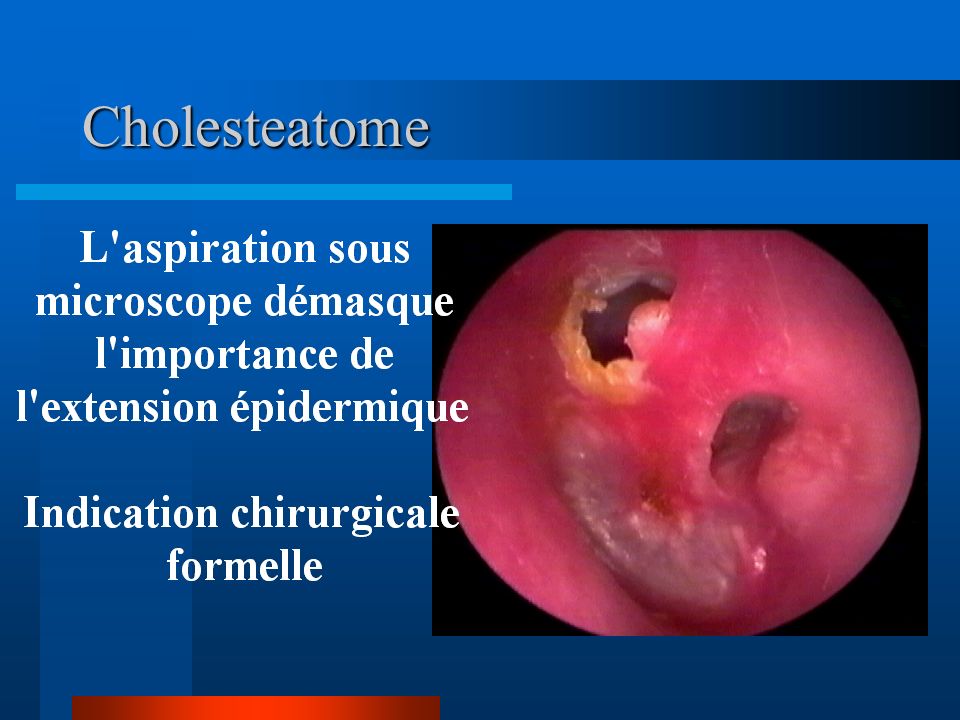 Cholesteatome