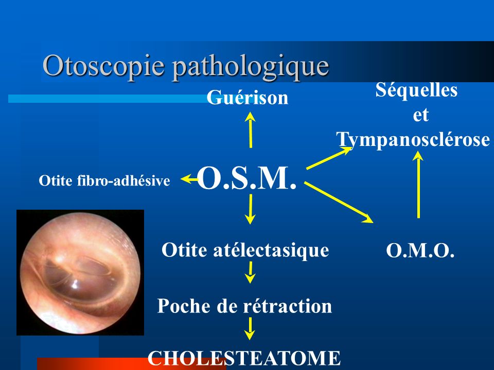 Otoscopie pathologique