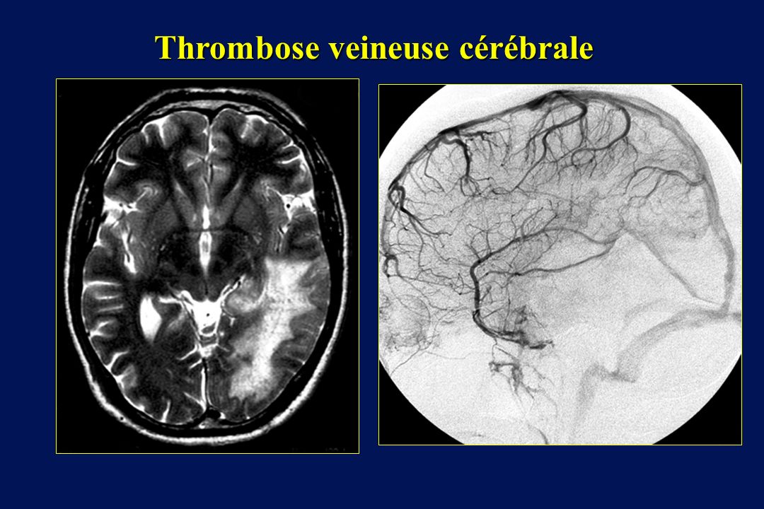 Thrombose veineuse cérébrale