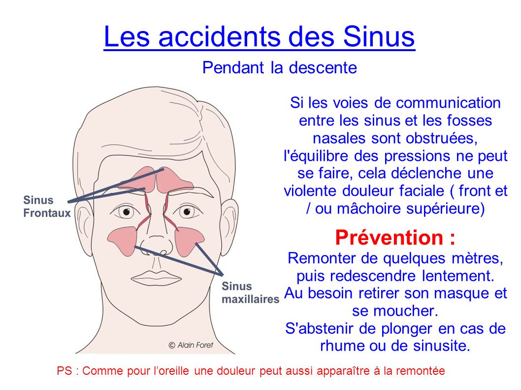 Les accidents des Sinus