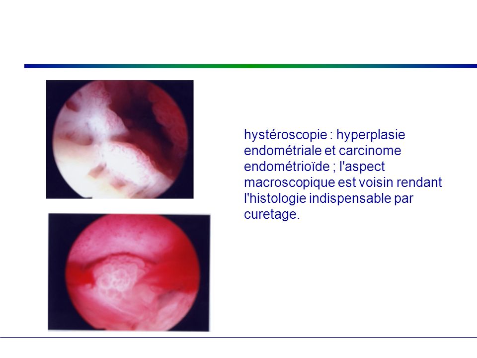 hystéroscopie : hyperplasie endométriale et carcinome endométrioïde ; l aspect macroscopique est voisin rendant l histologie indispensable par curetage.