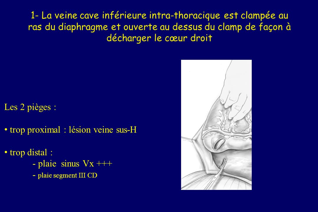 1- La veine cave inférieure intra-thoracique est clampée au ras du diaphragme et ouverte au dessus du clamp de façon à décharger le cœur droit