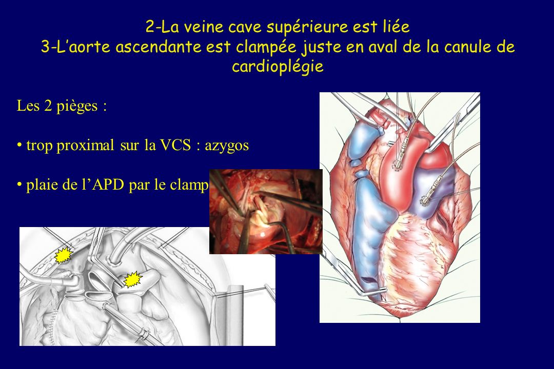 2-La veine cave supérieure est liée 3-L’aorte ascendante est clampée juste en aval de la canule de cardioplégie