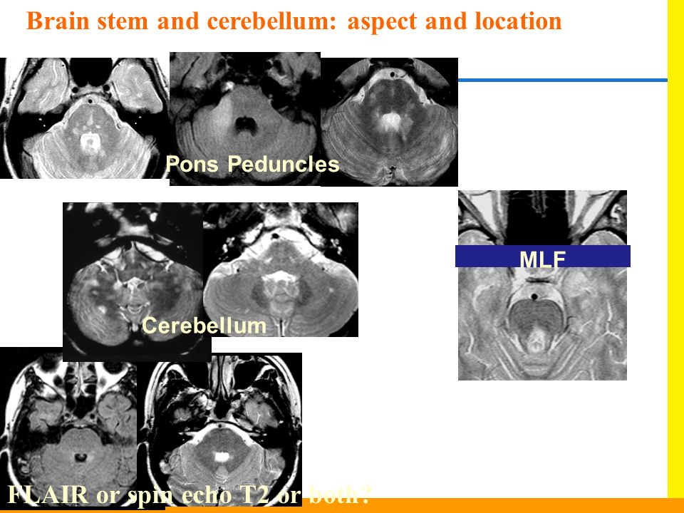 Brain stem and cerebellum: aspect and location