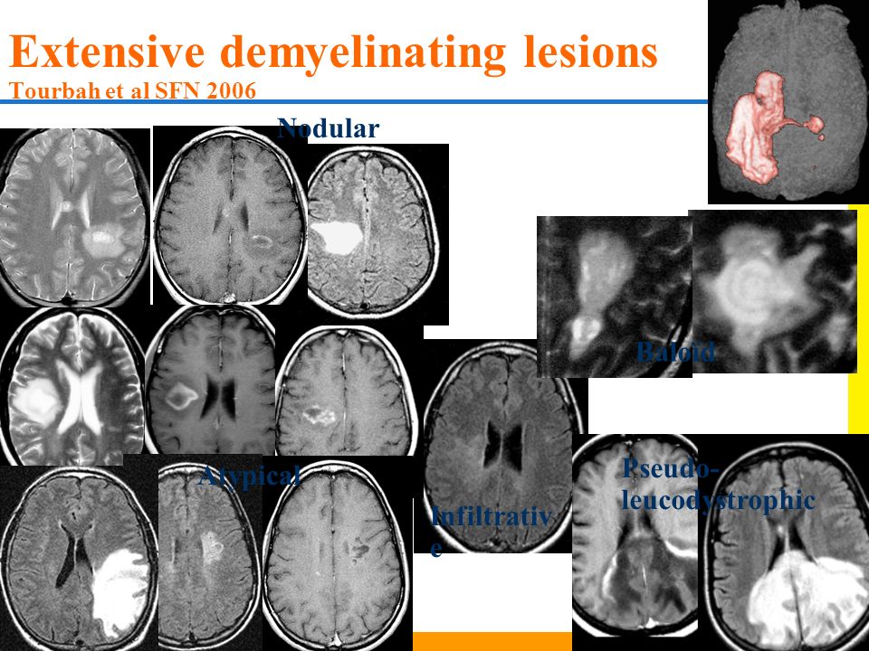 Extensive demyelinating lesions Tourbah et al SFN 2006
