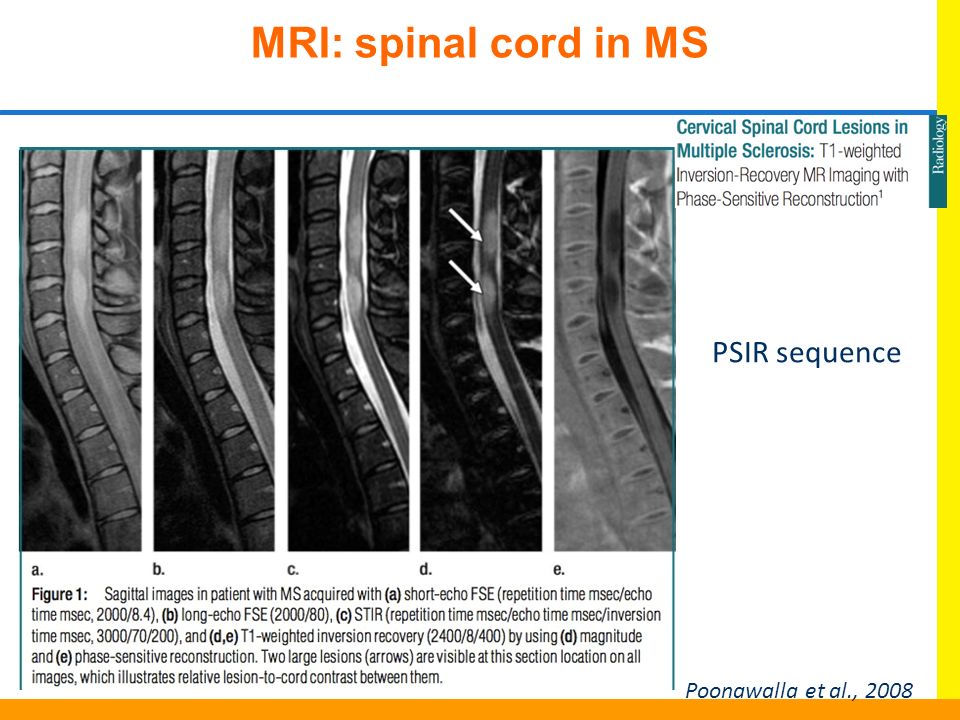 MRI: spinal cord in MS PSIR sequence Poonawalla et al., 2008
